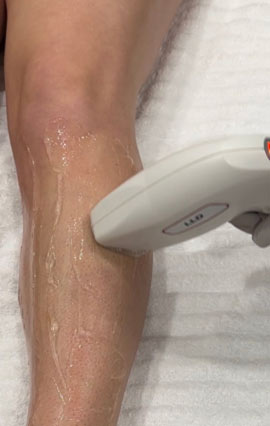 Laser Hair Removal Memphis TN Embrace Skin and Wellness